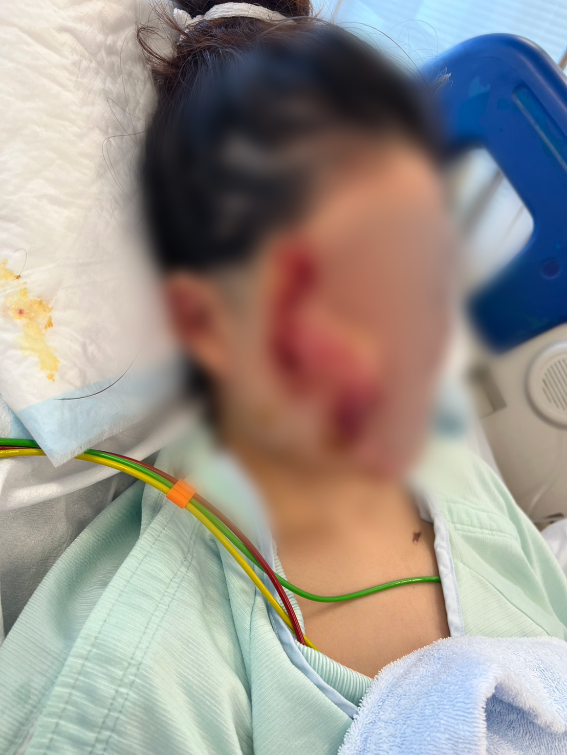 美容の道目指し韓国に旅行し留学間近だった自転車女性。後ろから酒車カスに轢かれ顔身体に消せない傷