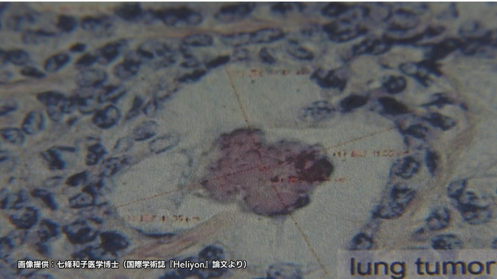 デスボール。70年後に死ぬ。広島で入市被爆した女性の肺からウランとデスボールが発見される。